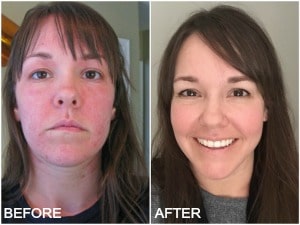 Steroid moon face before and after