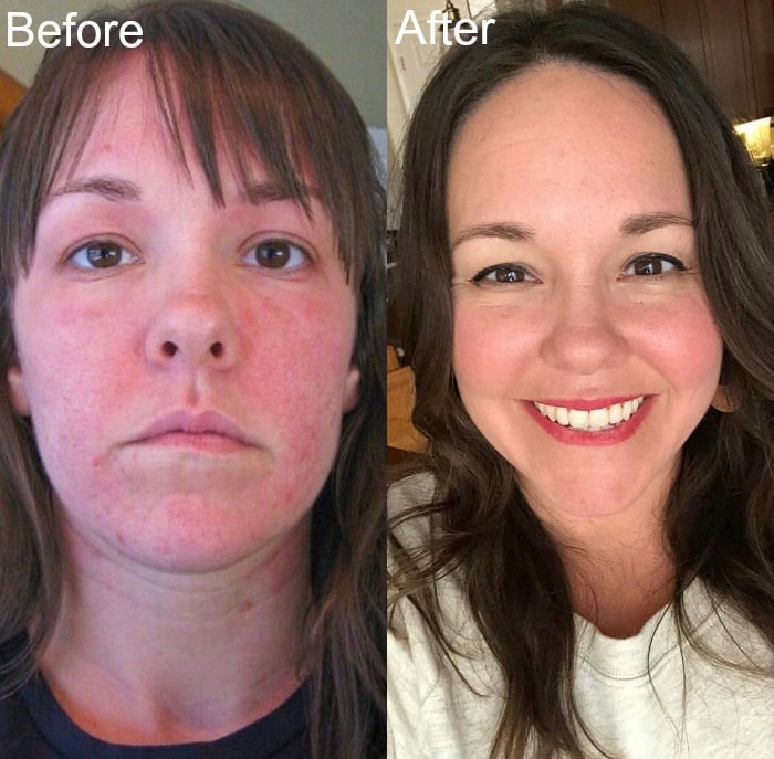 hypothyroidism before and after face