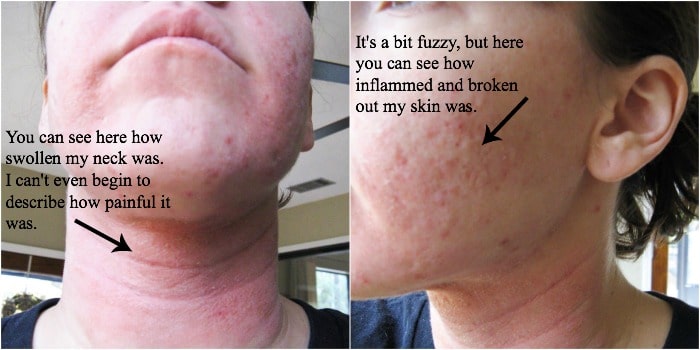 Hypothyroidism Skin Rash Pictures Photos