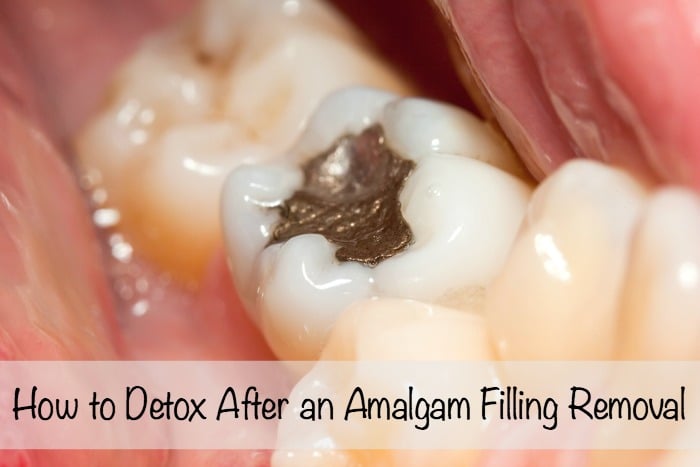 How to Detox After Amalgam Filling Removal