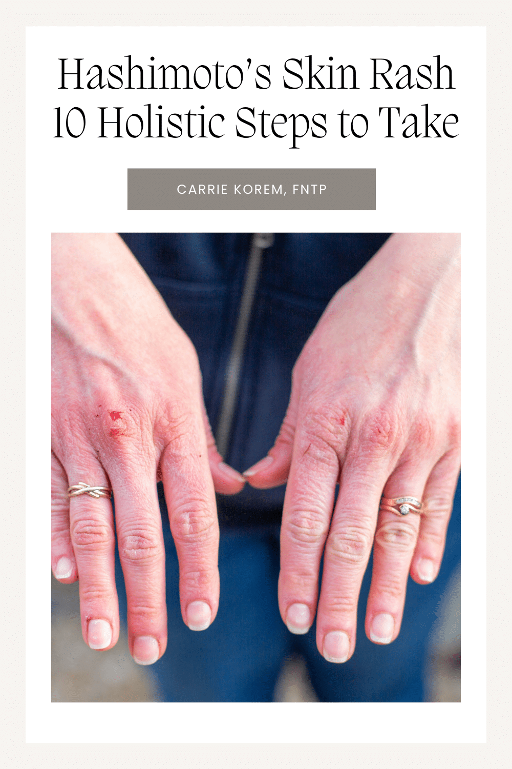 Hashimoto's Skin Rash and 10 Holistic Steps to Take